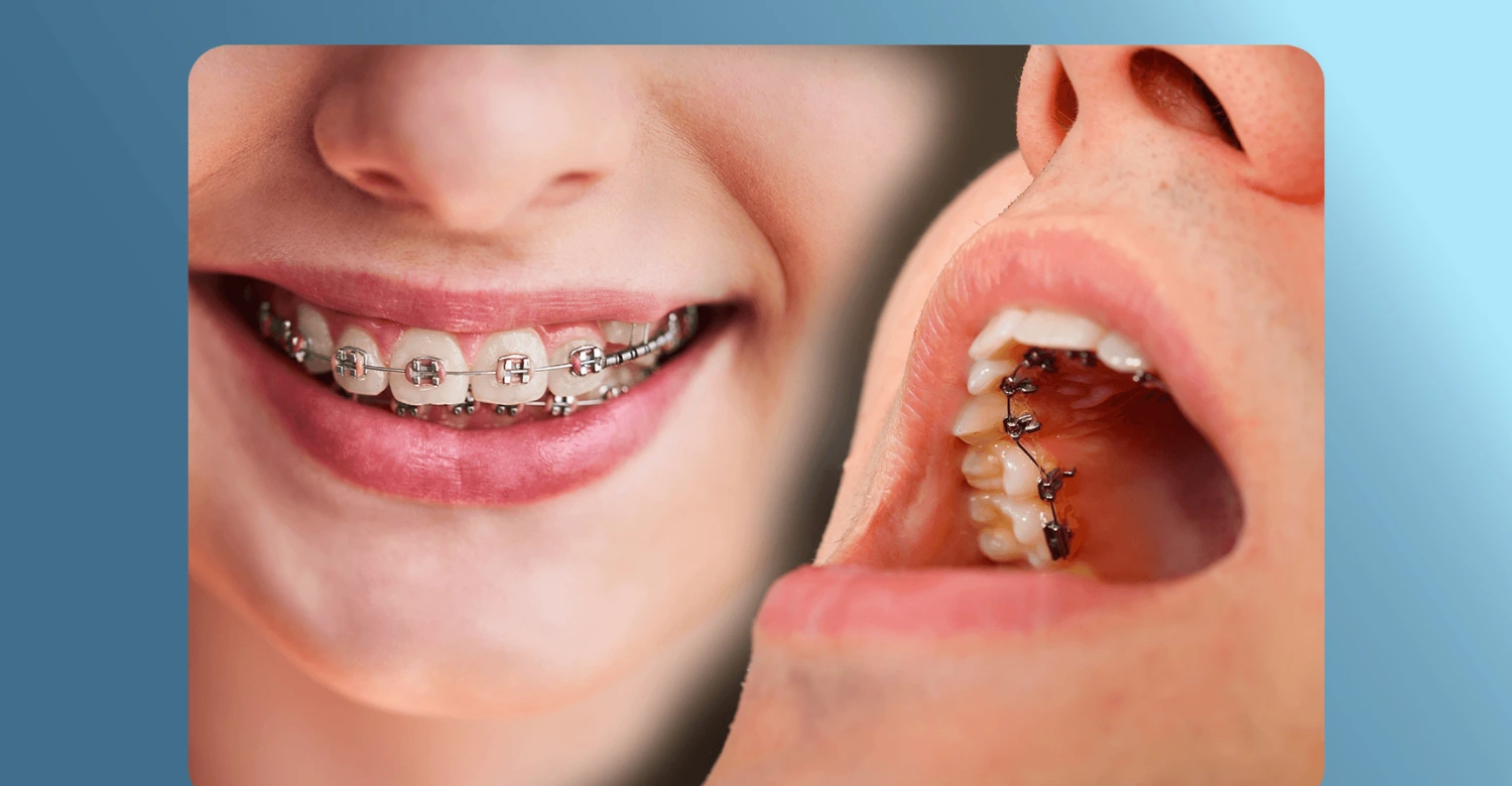 Lingual vs Traditional Braces 2